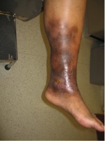 Picture of typical venous skin changes