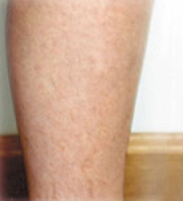 before and after varicose vein