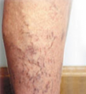 before and after varicose vein