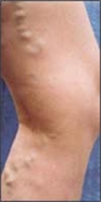 before and after varicose vein